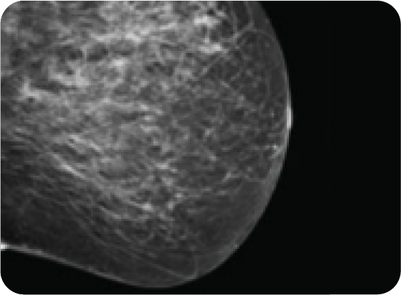 dense breast tissue under mammography